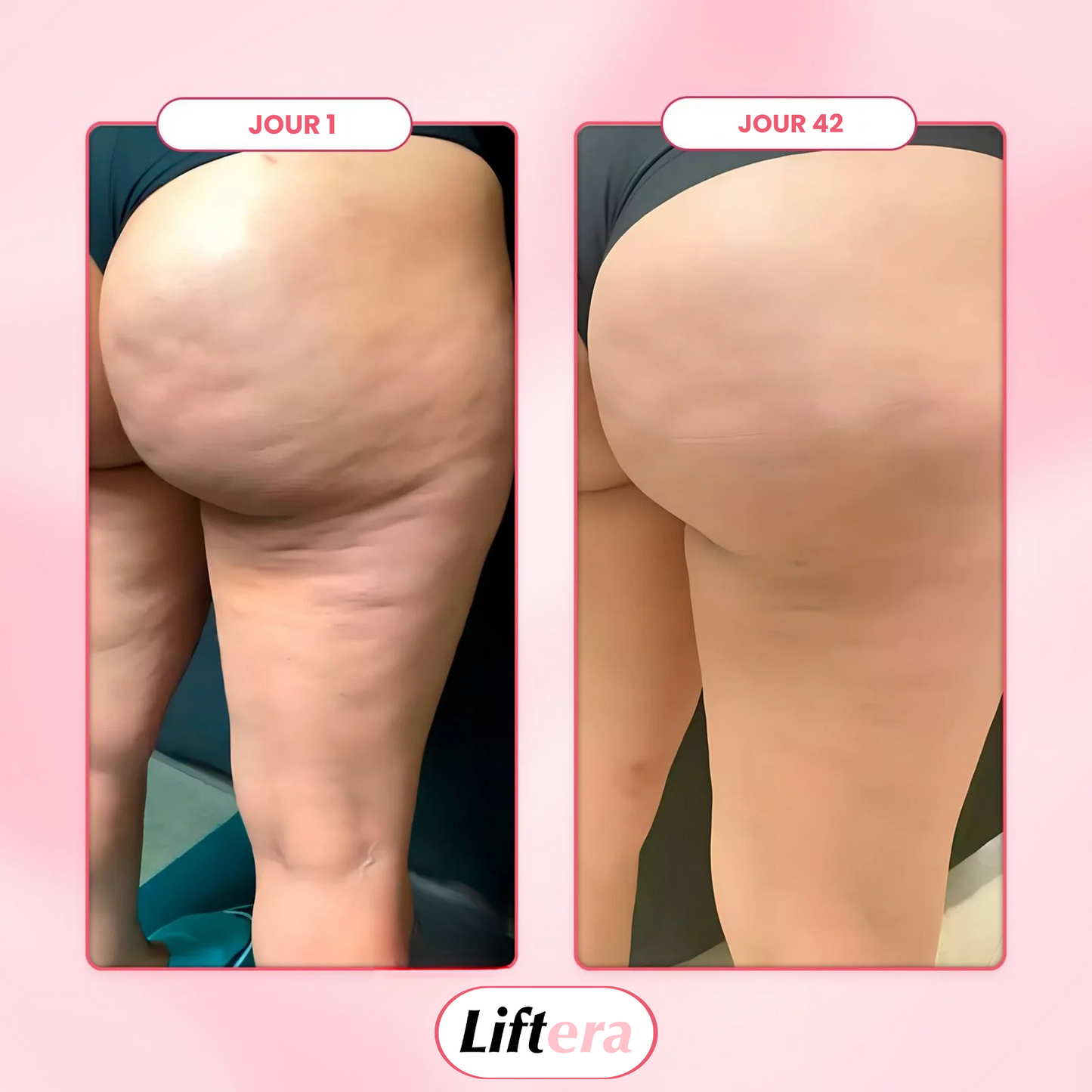 Liftera - Masseur anti-cellulite